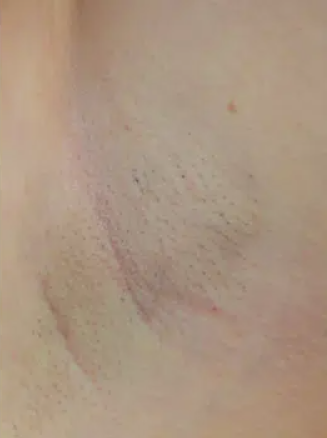 Epilare-After