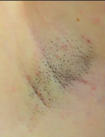 Epilare-Before